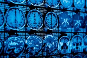 Texas A&M Trains AI to Identify Alzheimer’s Stage Using Multimodal Patient Data